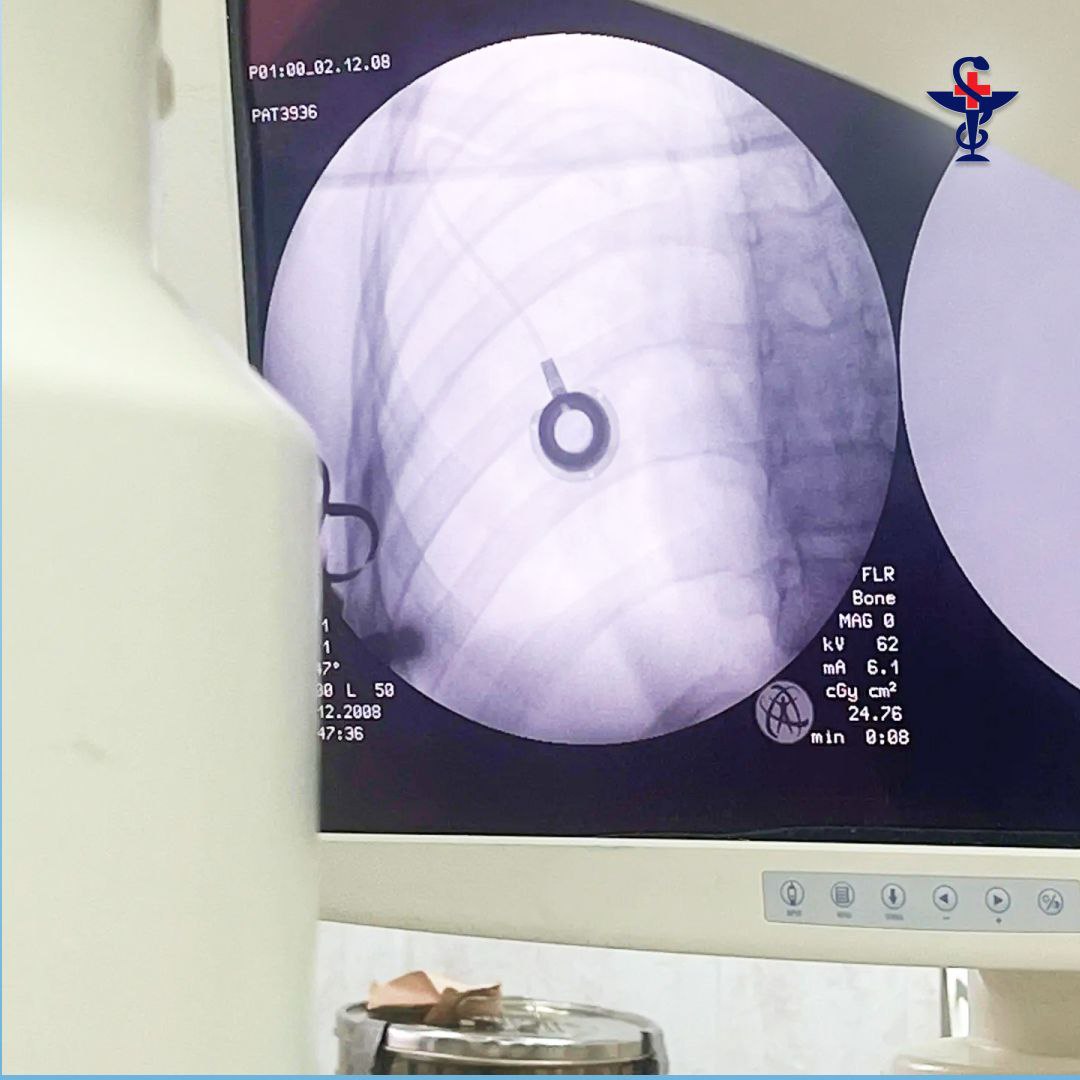 Врачи областной детской больницы сами установили порт-систему юному пациенту с онкозаболеванием, рассказали в Минздраве Врачи областной детской больницы сами установили порт-систему юному пациенту с онкозаболеванием, рассказали в Минздраве